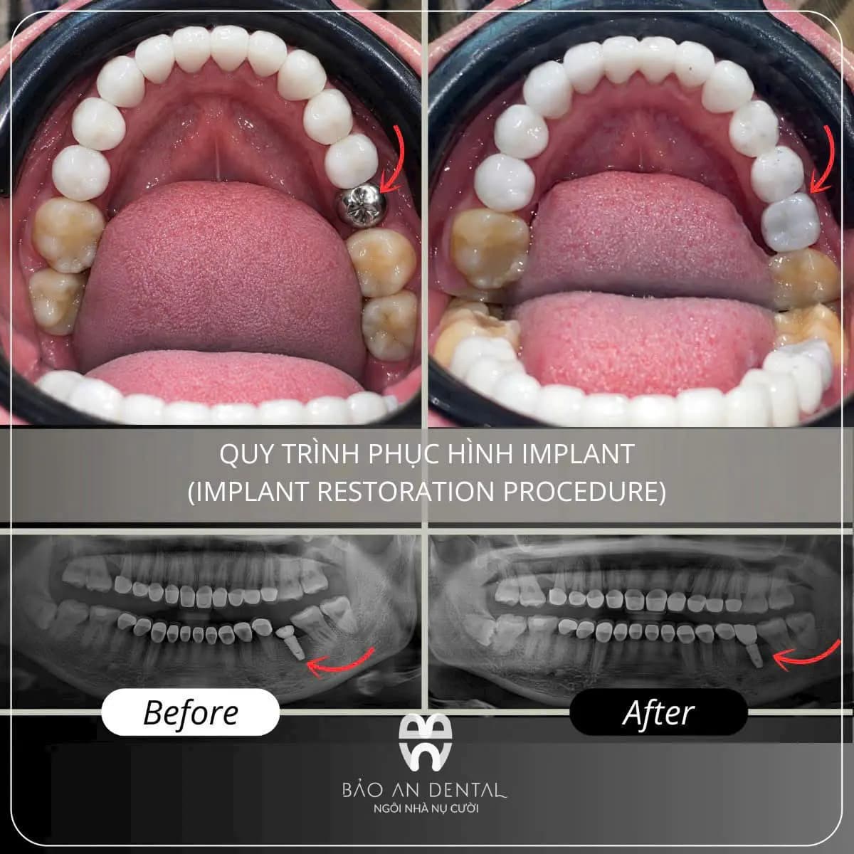 Kết quả điều trị trước và sau: Implant & phục hình