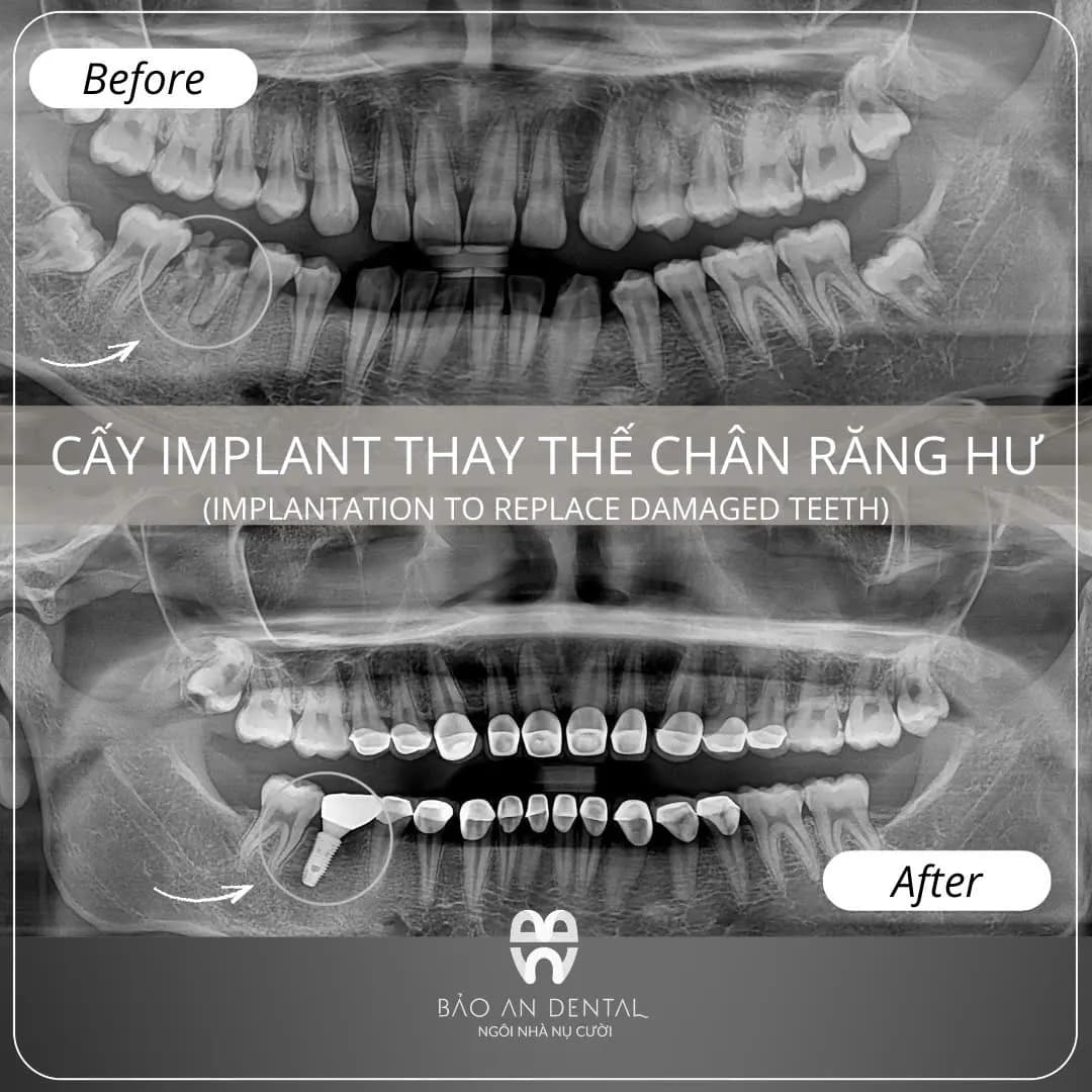 Kết quả điều trị trước và sau: Implant & phục hình