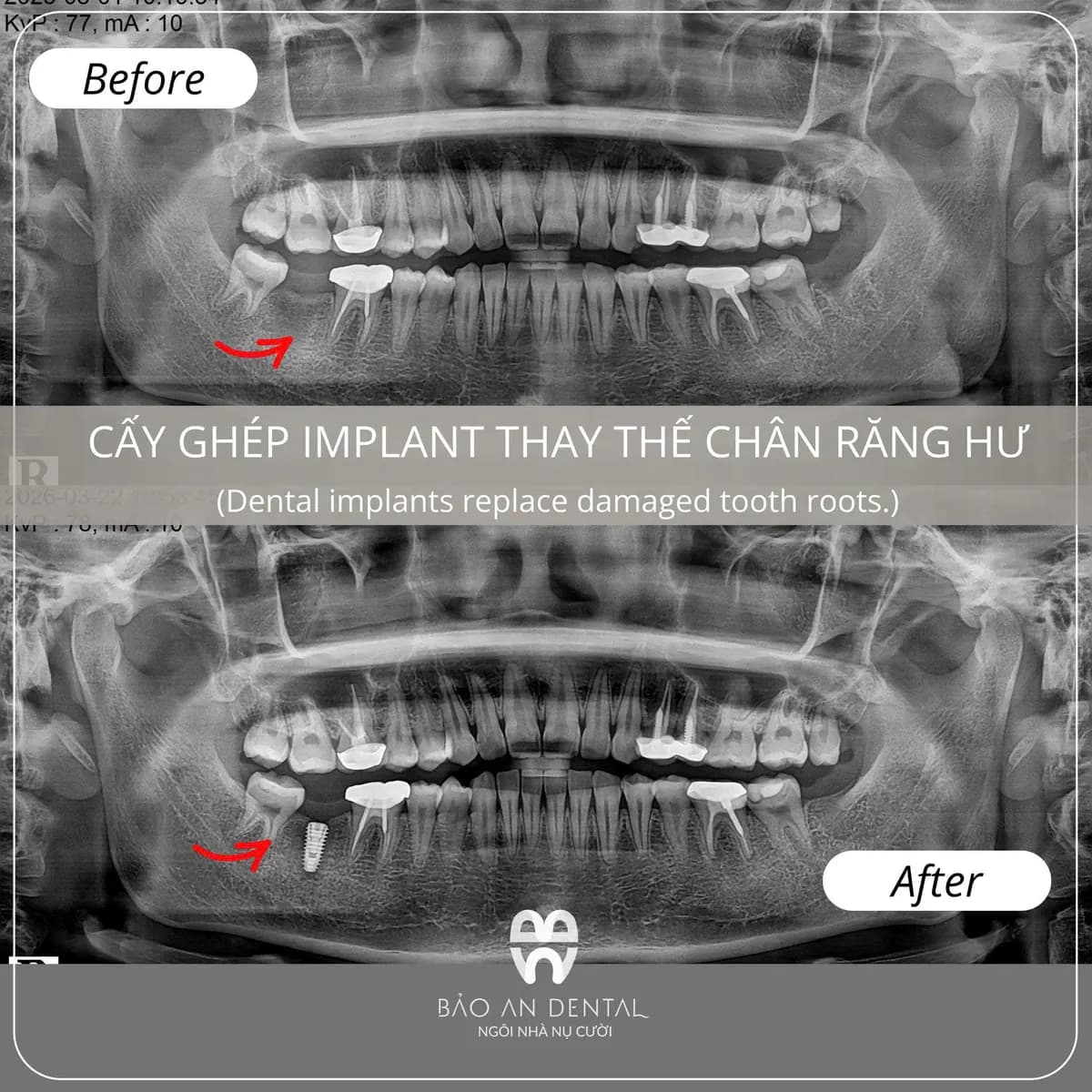 Kết quả điều trị trước và sau: Implant & phục hình