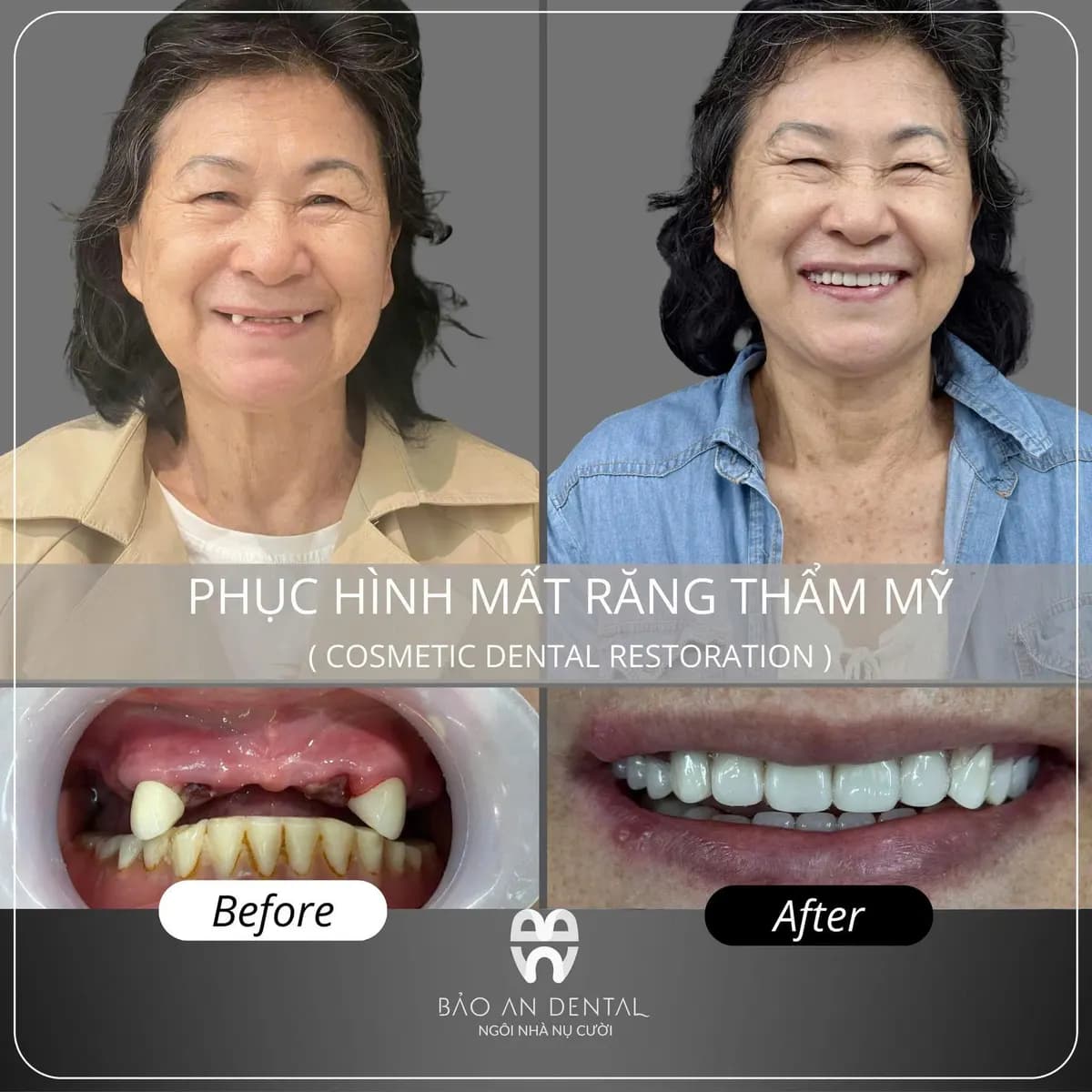 Kết quả điều trị trước và sau: Implant & phục hình
