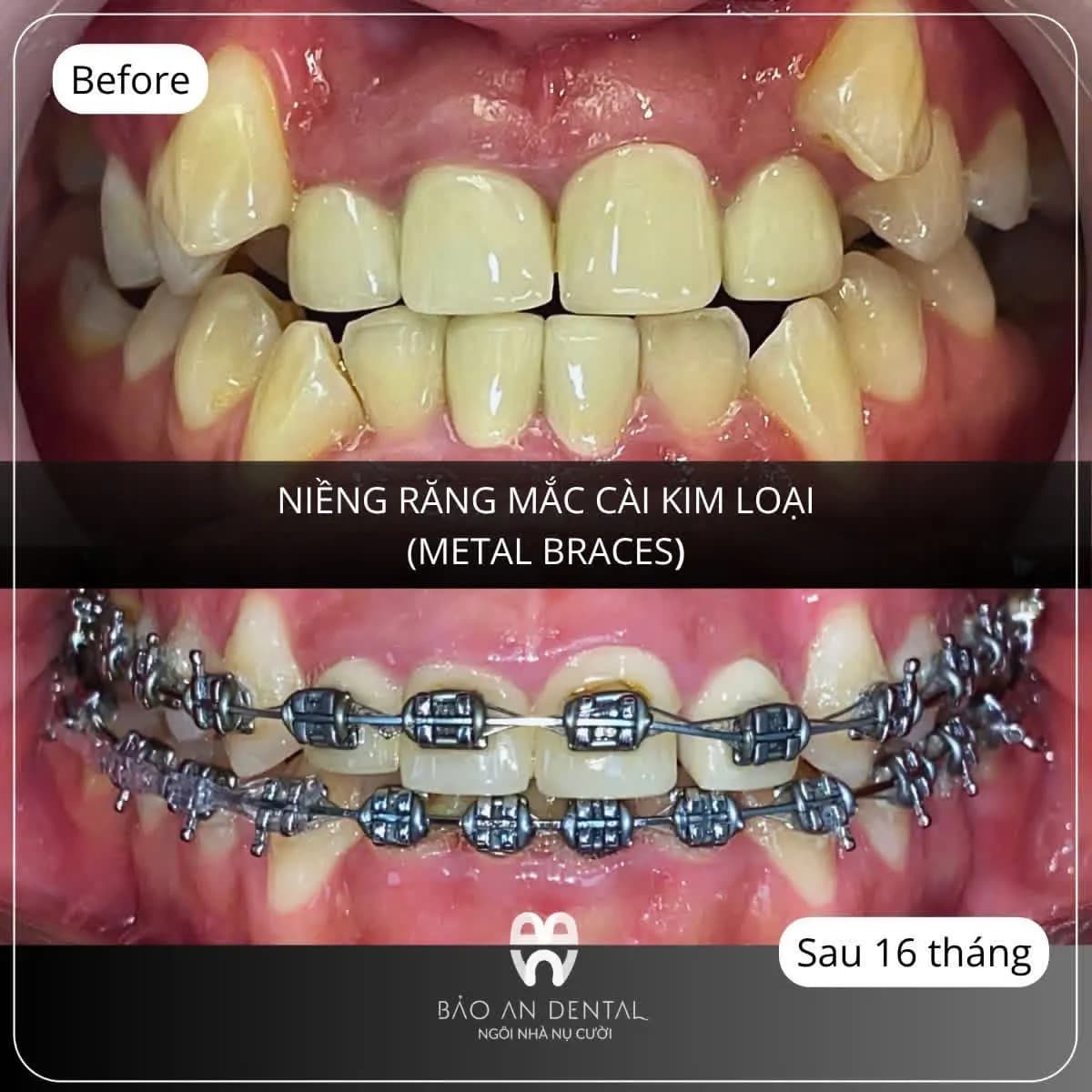 Kết quả điều trị trước và sau: Niềng răng