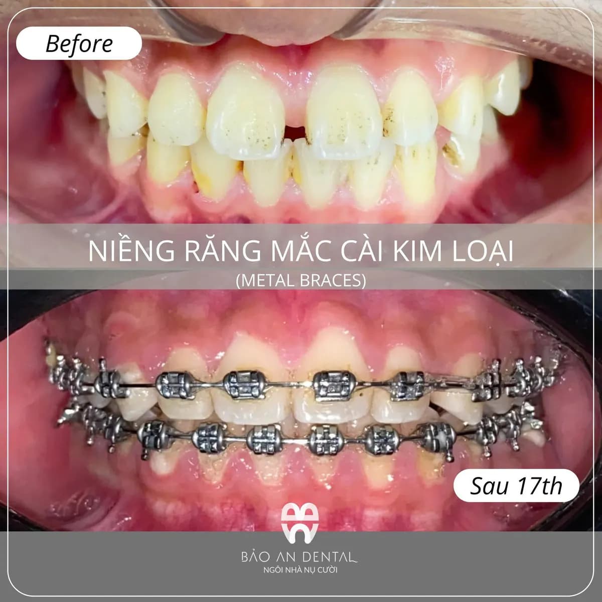 Kết quả điều trị trước và sau: Niềng răng