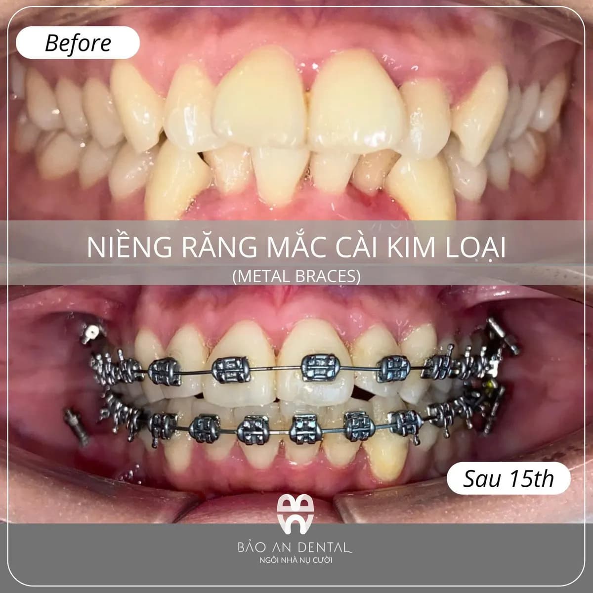 Kết quả điều trị trước và sau: Niềng răng