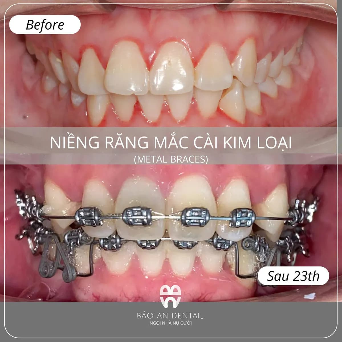 Kết quả điều trị trước và sau: Niềng răng