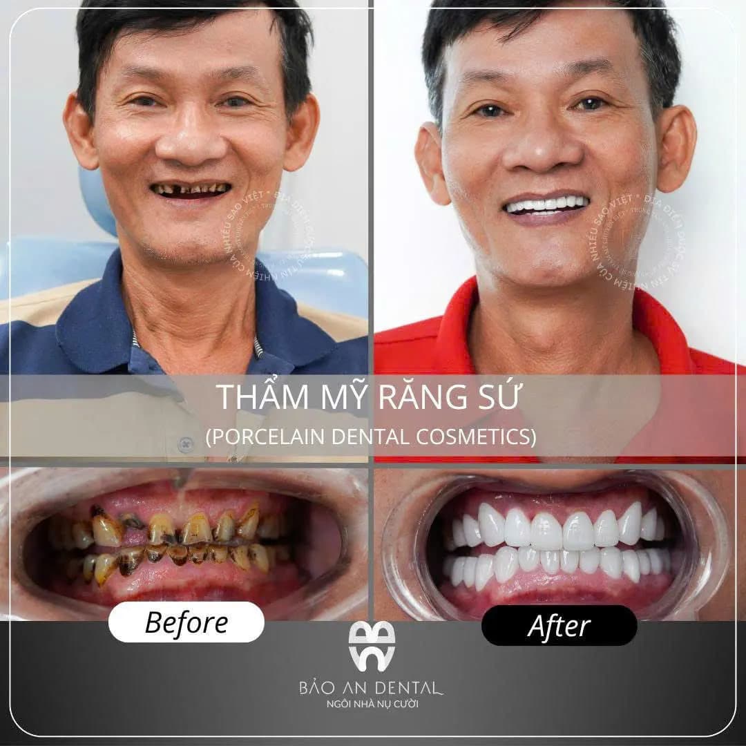 Kết quả điều trị trước và sau: Thẩm mỹ răng sứ
