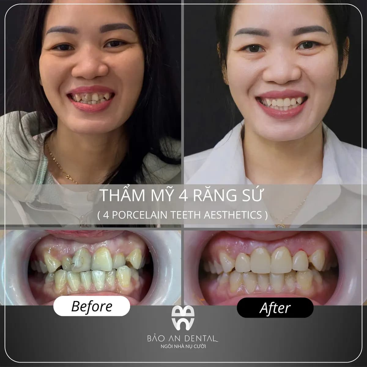 Kết quả điều trị trước và sau: Thẩm mỹ răng sứ