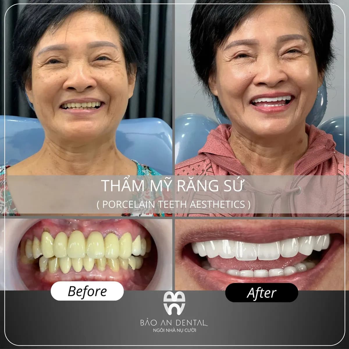 Kết quả điều trị trước và sau: Thẩm mỹ răng sứ
