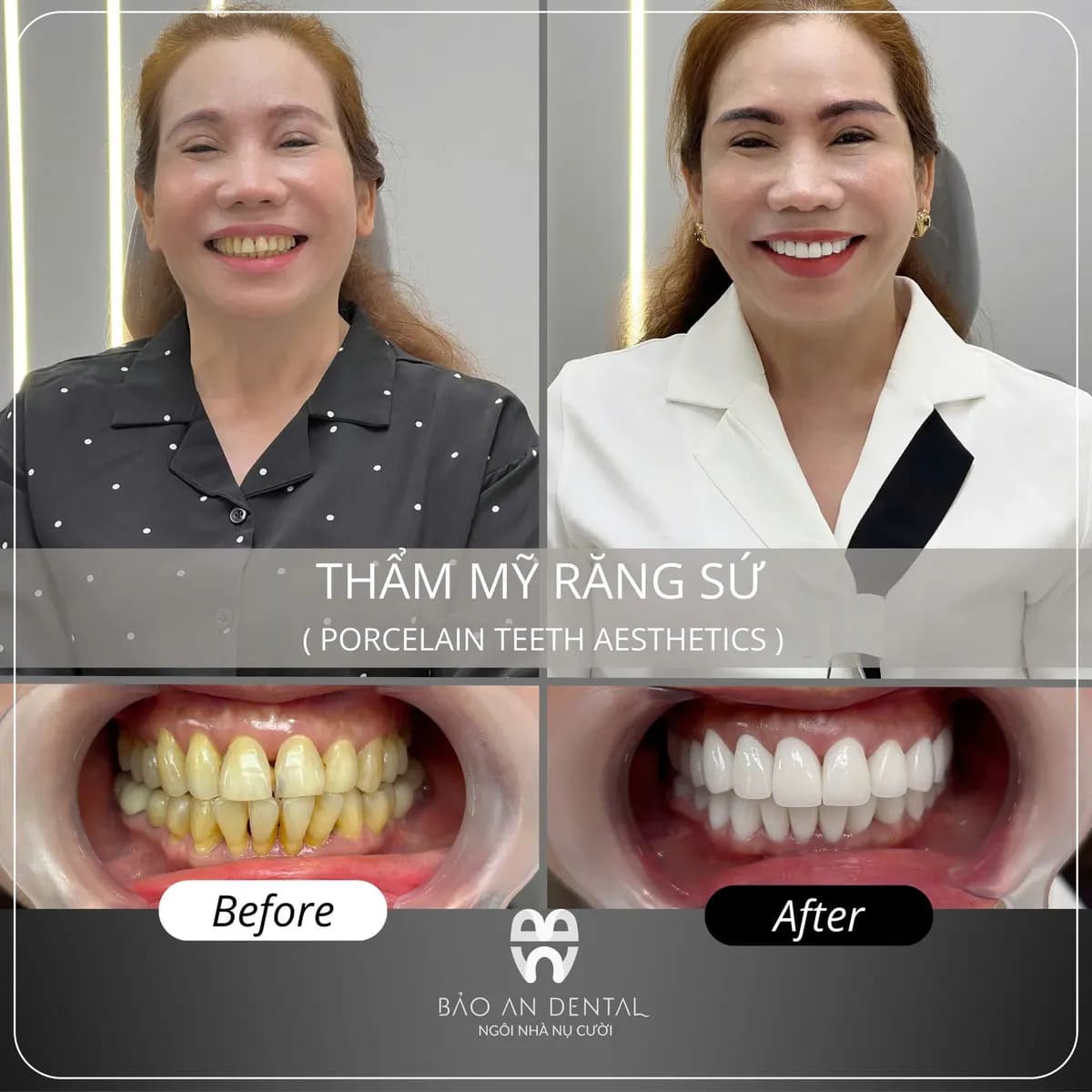 Kết quả điều trị trước và sau: Thẩm mỹ răng sứ