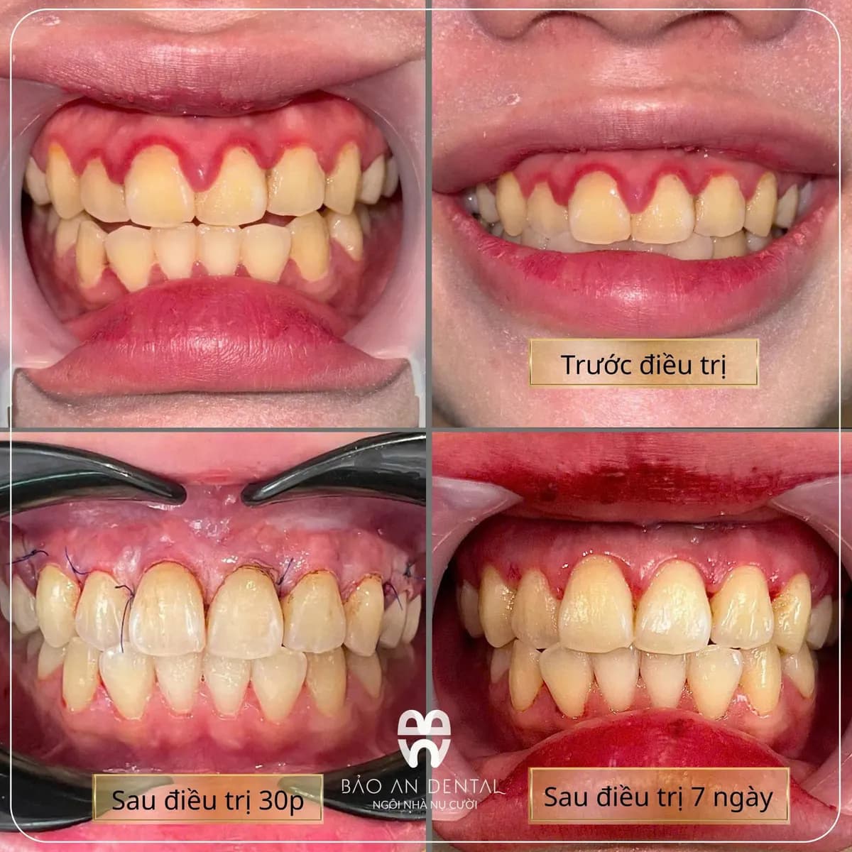 Kết quả điều trị trước và sau: Thẩm mỹ răng sứ