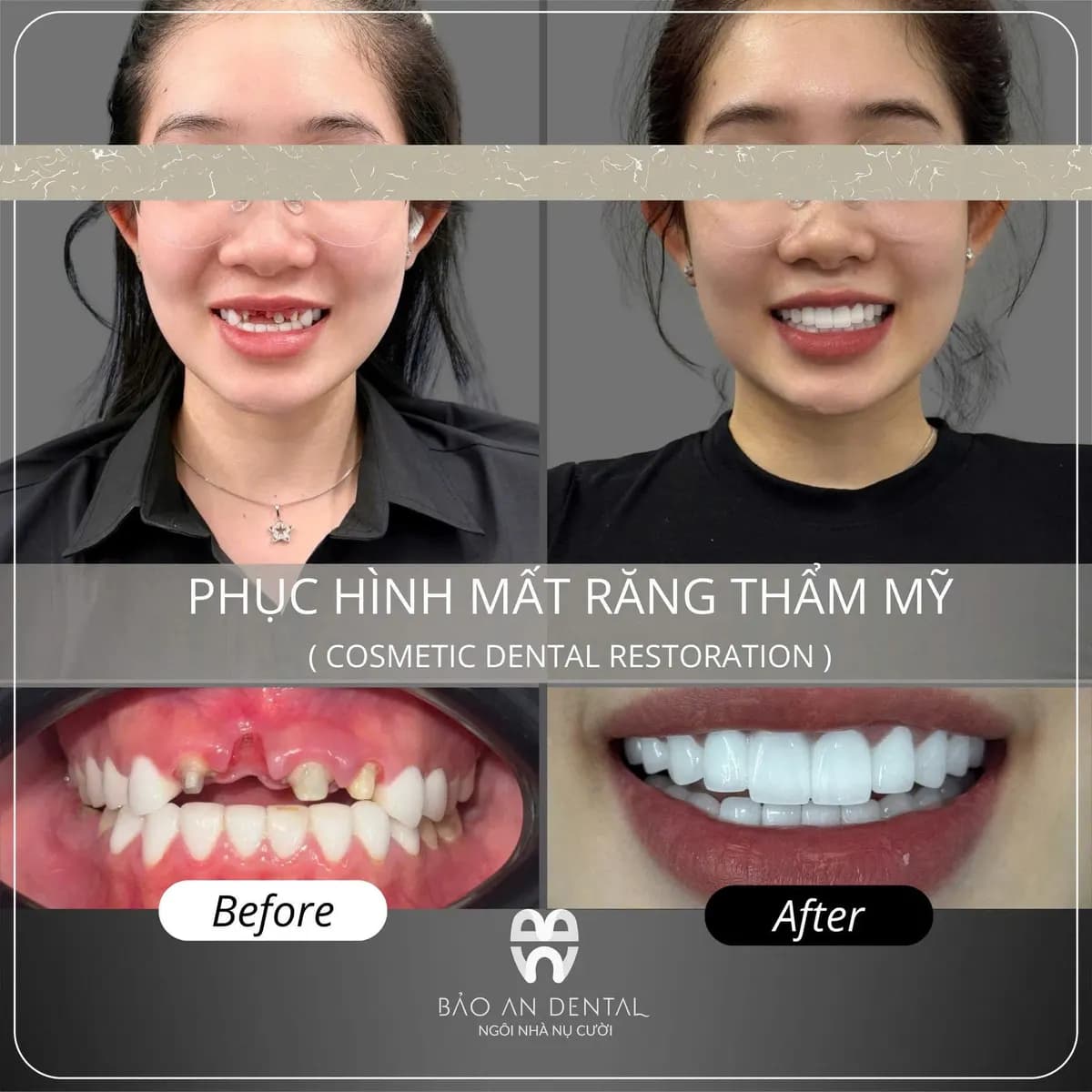 Kết quả điều trị trước và sau: Thẩm mỹ răng sứ
