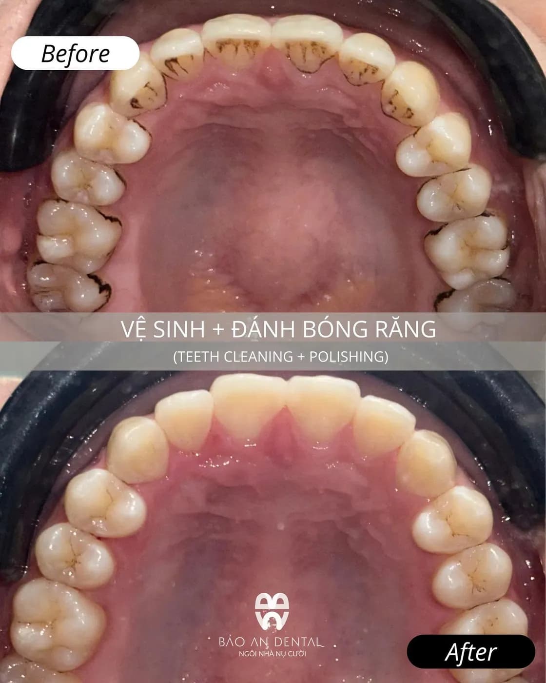 Răng trước và sau khi cạo vôi, đánh bóng