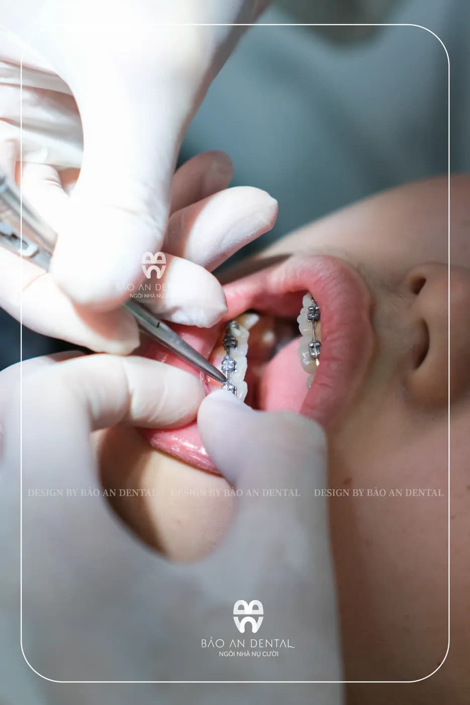 Bác sĩ gắn mắc cài cho khách hàng