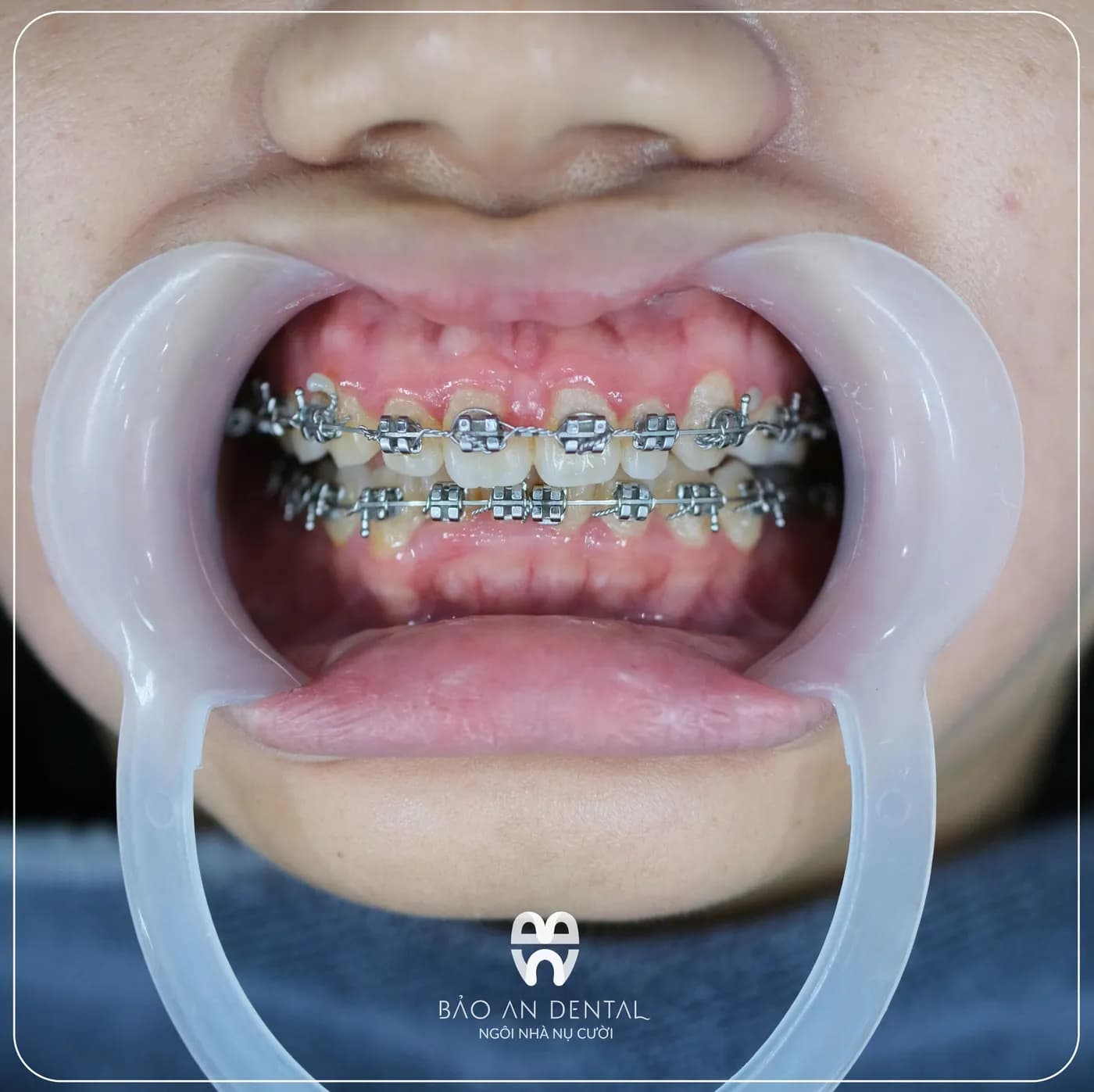 Niềng răng mắc cài kim loại tại Bảo An Dental